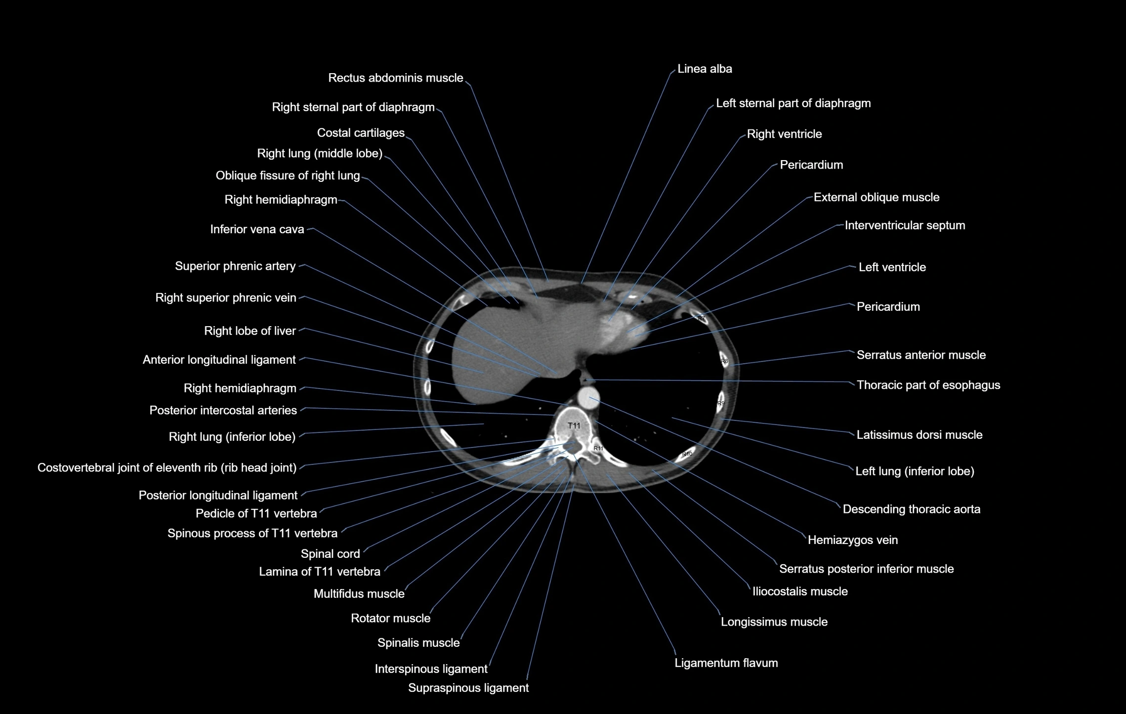 CT chest (thorax) labelled axial cross sectional anatomy radiology image-00100.webp
